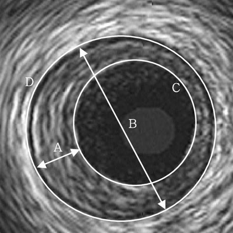 Measurement Of The Carotid Intima Media Thickness Imt The Values Of