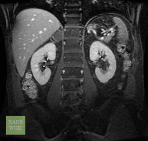 Adrenal Adenoma Mri Radrounds Radiology Network