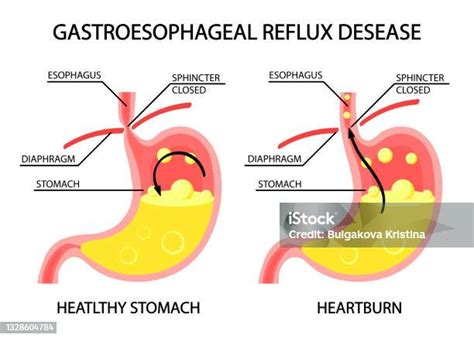 Human Stomach Gastroesophageal Reflux Disease Gerd Heartburn Gastric