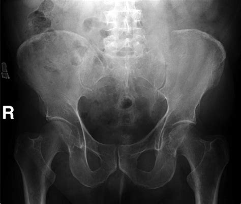 A Axial Ct Scan Of The Pelvis Bone Window Demonstrating A Soft