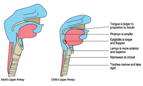 PEDS Upper Airway Flashcards Quizlet