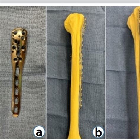 A B C Implants Utilized Synthes 3 5 Mm LCP Proximal Humerus Plate