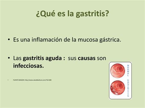 Gastritis Powerpoint Ppt Descarga Gratuita