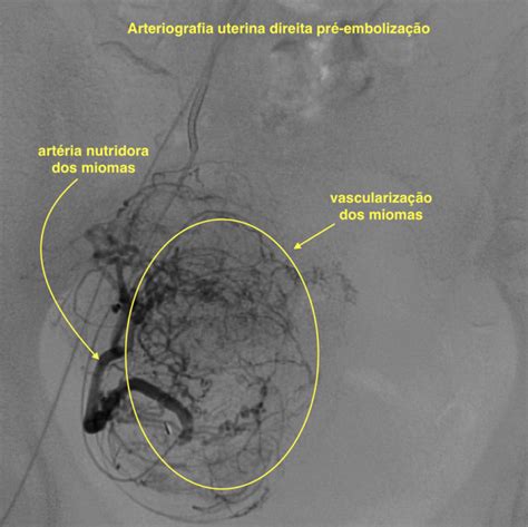 Emboliza O De Miomas Uterinos