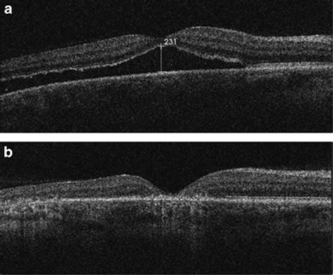 OCT scans for the same patient with chronic retinal detachment... | Download Scientific Diagram