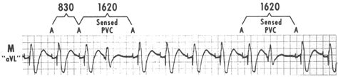 Figure 1 From Ventricular Tachycardia Produced By A Normally Functioning Av Sequential Demand