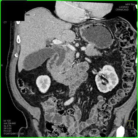 Pancreatic Cancer With Liver Metastases And Incidental Pericardial Cyst