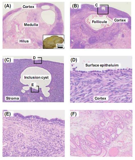 Cancers Free Full Text Ovarian Cancer Stroma Pathophysiology And