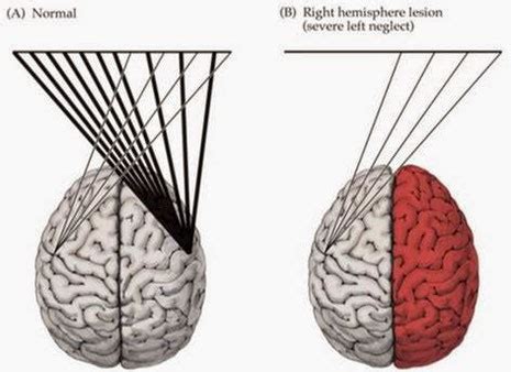 Qu Es La Heminegligencia Estimulaci N Cognitiva Global