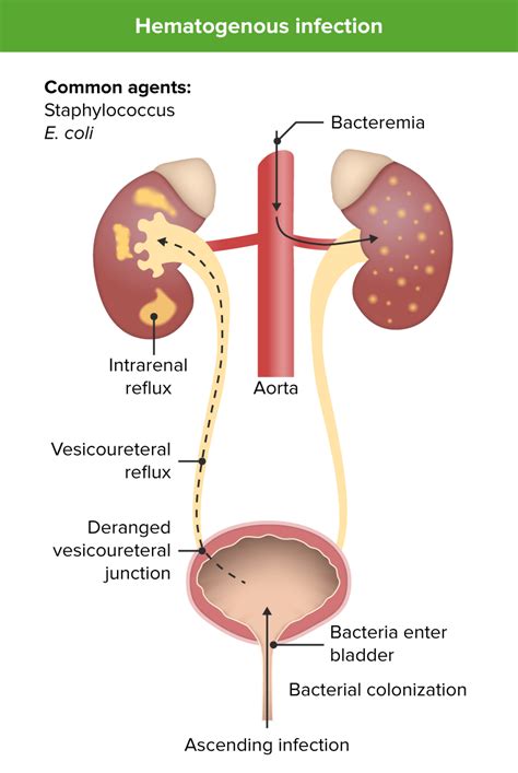 Urinary Tract Infections Utis In Children Concise Medical Knowledge