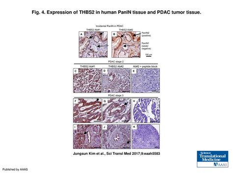 Expression Of Thbs In Human Panin Tissue And Pdac Tumor Tissue Ppt