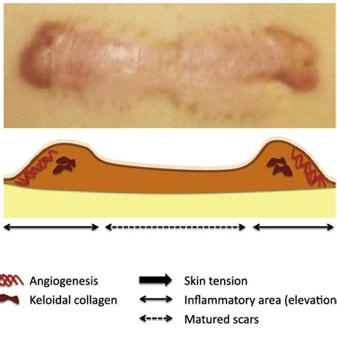 Scar Severity Keloids And Hypertrophic Scars Are Multifactorial