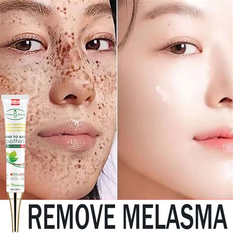 Cod Whitening Freckle Dark Spot Remover Melasma Cream Acne Spot