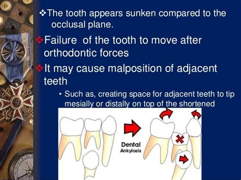 ankylosis of teeth