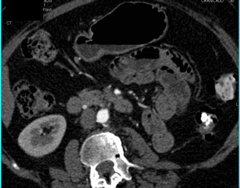 Renal Cell Carcinoma Metastatic To The Pancreas With Vascular