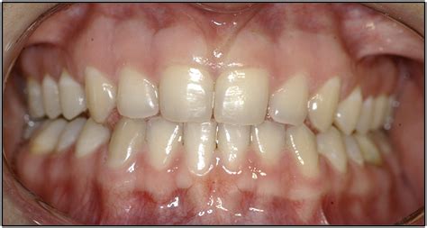 Tongue Squamous Cell Carcinoma In Young Nonsmoking And Nondrinking Patients 3 Clinical Cases Of