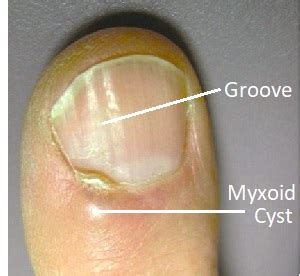 Digital Mucous Cyst Causes Treatment For Myxoid Cysts