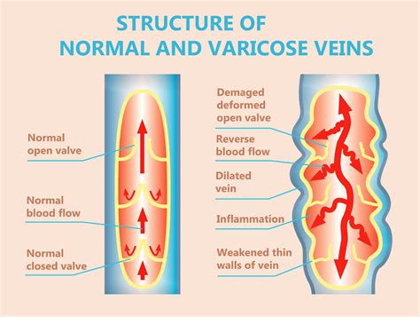 Top Warning Signs Of Deep Venous Reflux Vascular Specialists