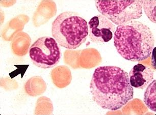 herenciageneticayenfermedad Leucemia mielógena crónica LMC