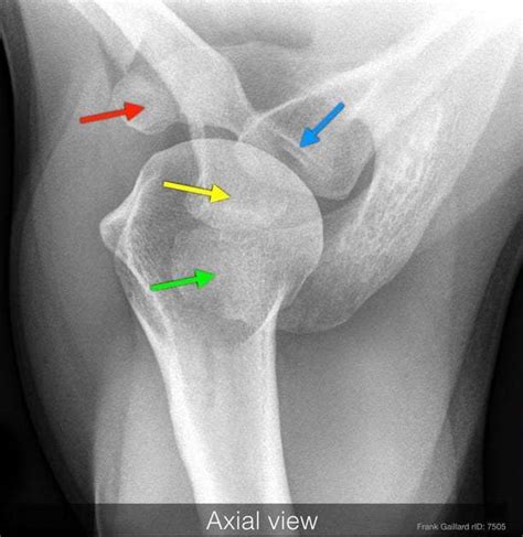 Infraglenoid Tubercle Of Scapula