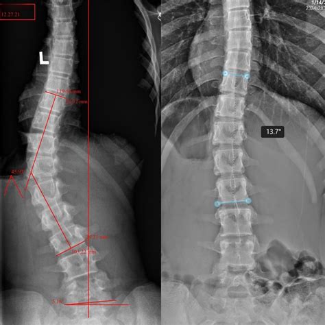 Strauss Scoliosis Correction Keeping Patients Ahead Of The Curve