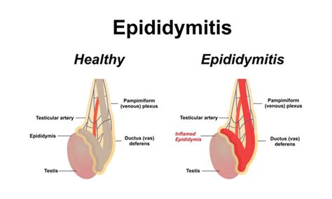 Epididymitis Symptoms In Women