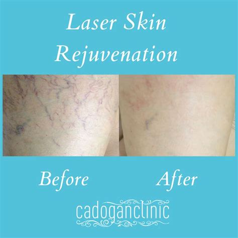 Laser Hair Rejuvenation Refresh Your Skin With Our Amazing Laser Skin