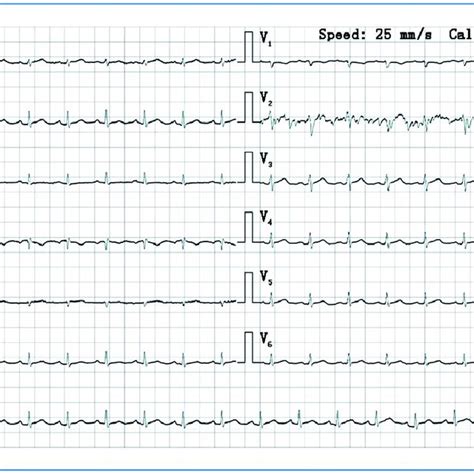 12 Lead Electrocardiogram Electrocardiogram After Admission Showed