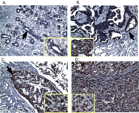 Overexpression Of Vav3 In Human Breast Cancer A The Normal Breast