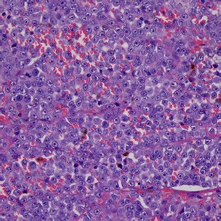 Nasal Melanoma Showing Round Nuclei And Prominent Nucleoli Melanin