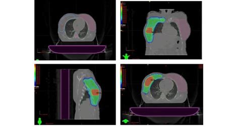 Dose Distribution Of Simultaneous Integrated Boost Intensity Modulated Download Scientific