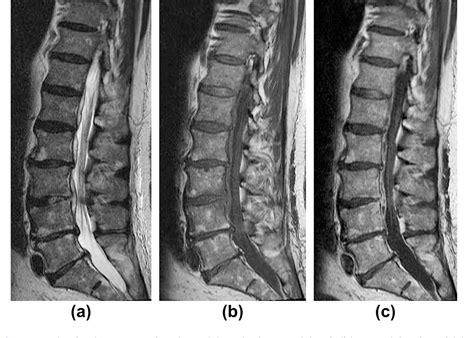 Figure From The Mri Appearances Of Early Vertebral Osteomyelitis And