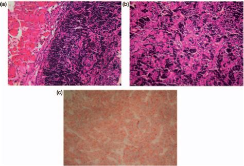 Figure From Skeletal Muscle Metastases From Lung Cancer Semantic