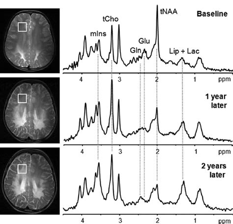 Single Voxel H Mr Spectroscopy Shows Progression Of Disease In Boy