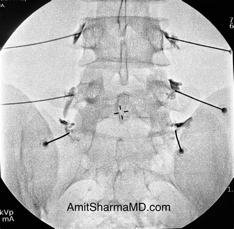 Amit Sharma Md Lumbar Facet Joint Injections Long Island Ny