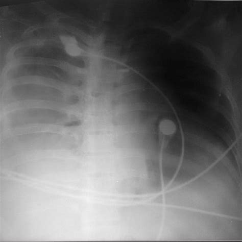 Radiograph shows resolving pulmonary edema after 12 h postoperative... | Download Scientific Diagram