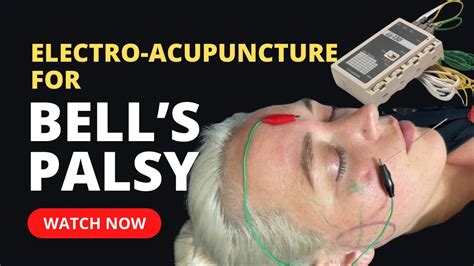 Electroacupuncture Treatment For Bells Palsy Youtube