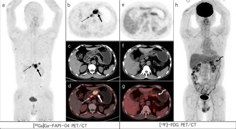 Frontiers Comparison Of Diagnostic Efficacy Of 68Ga Ga FAPI 04 And