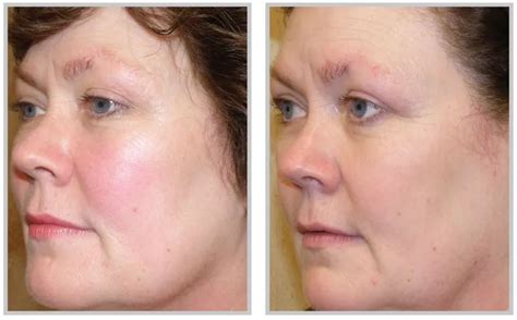 Rosacea Treatment Before And After