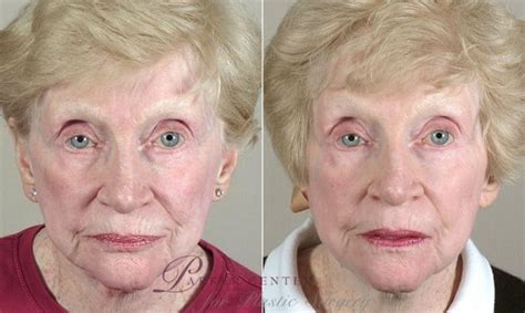 Facelift Before And After Pictures Case 35 Paramus New Jersey Parker Center For Plastic Surgery