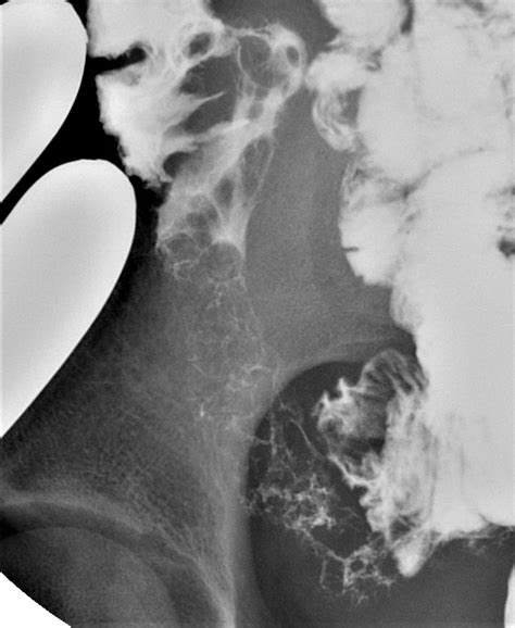 Cobblestoning Terminal Ileum Image