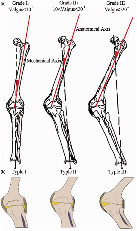 Knee Valgus Vs Varus