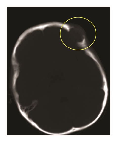 Images Obtained From A 3 Year Old Female With Imt Of The Frontal Bone Download Scientific