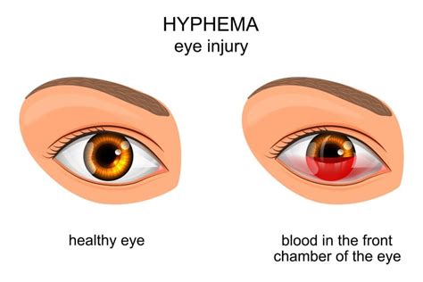 Understanding Hyphema: Symptoms, Treatment & More – NVISION