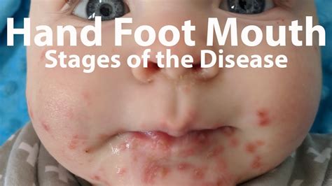 Hand Foot And Mouth Disease Rash Treatment