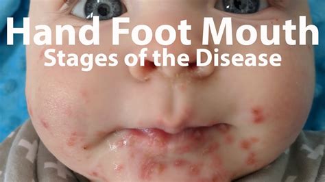 Foot And Mouth Disease - Atypical Hand Foot And Mouth Disease ...