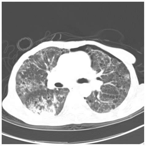 Management Of Pneumocystis Jirovecii Pneumonia In Hiv Infected Patients Current Options