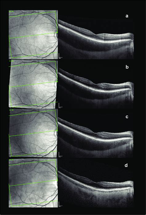 Series of four retina optical coherence tomography (OCT) scans of the ...