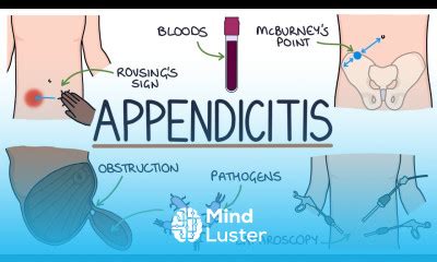 Learn Understanding Appendicitis Mind Luster