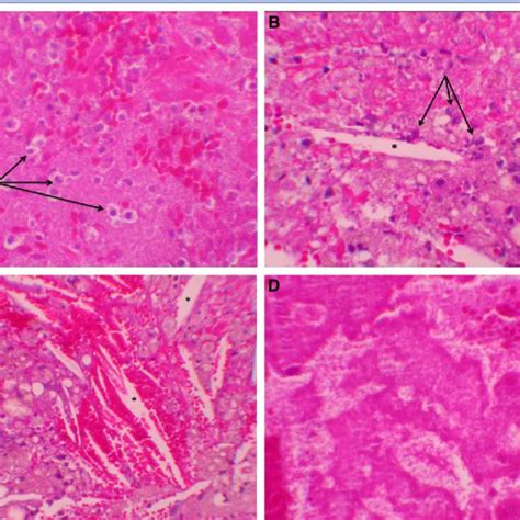 A Erythrocytes And Inflammatory Cells Embedded In Fibrin Deposits